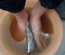 灰指甲怎么治疗?还有陈醋治疗方法